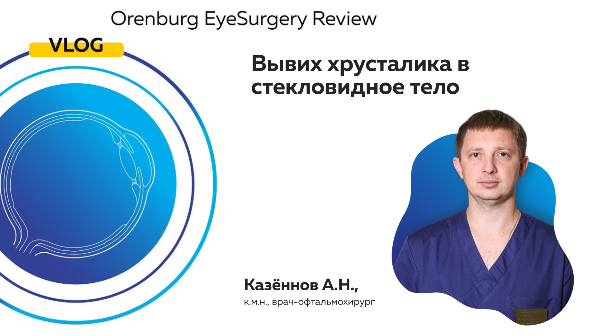 Вывих хрусталика в стекловидное тело