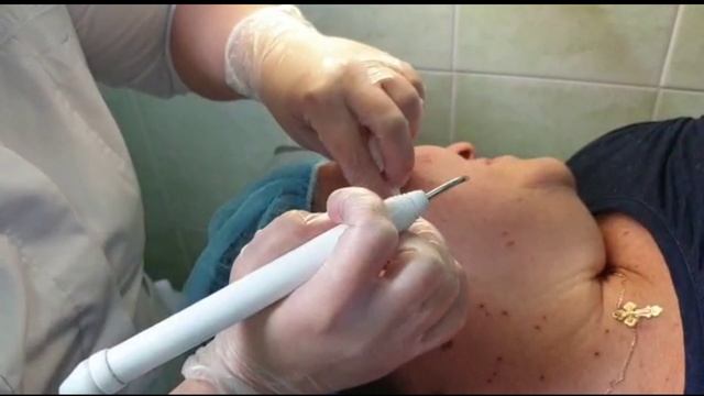 Удаление родинок на лице смотреть онлайн