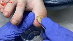 Онихолизис ногтей на ногах / Как вылечить онихолизис?