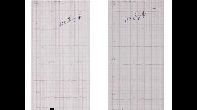 Дополнительные ЭКГ-отведения: ЭКГ на 2 межреберья выше и ниже стандартных точек