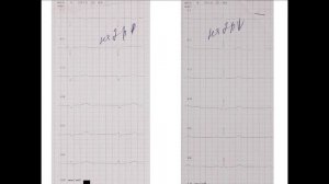 Дополнительные ЭКГ-отведения: ЭКГ на 2 межреберья выше и ниже стандартных точек