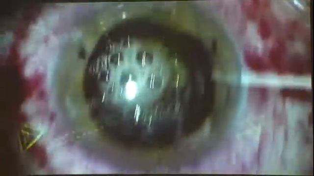 Факоэмульсификация на Centurion с имплантацией торической ИОЛ Acrysof Toric смотреть онлайн