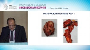 Рак ротоглотки.  Вчера и сегодня. Кропотов М.А.