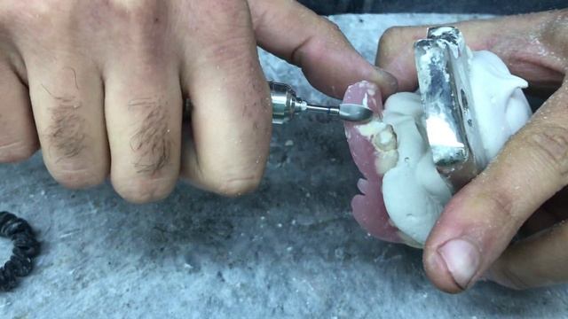 Перебазировка зубного протеза | Denture rebase смотреть онлайн