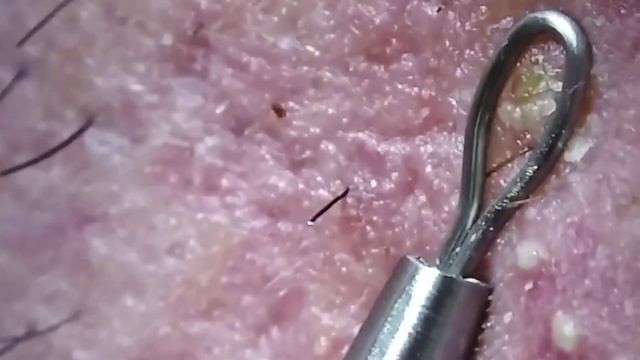 ✪ Satisfying Explosive Pimple Popping Videos | Pimple Popping #2 смотреть онлайн