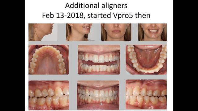 Dental Treatment: Accelerated Orthodontics Mar 26, 2020 смотреть онлайн