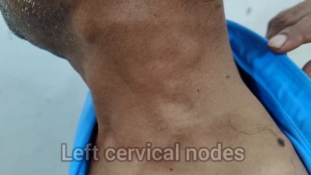 Clinical Examination of Lymph Nodes: Generalized Lymphadenopathy смотреть онлайн