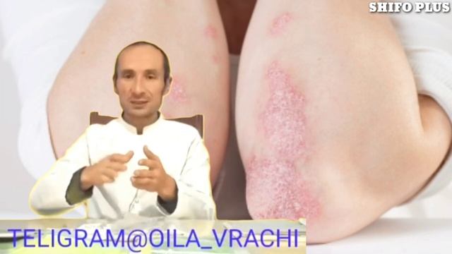 ПСОРИАЗ КАСАЛЛИГИ ХАКИДА ФОЙДАЛИ ТАФСИЯЛАР PSORIAZ KASALLIGI