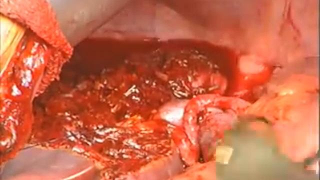 Extended Hepatic Resection for Hilar Cholangiocarcinoma смотреть онлайн