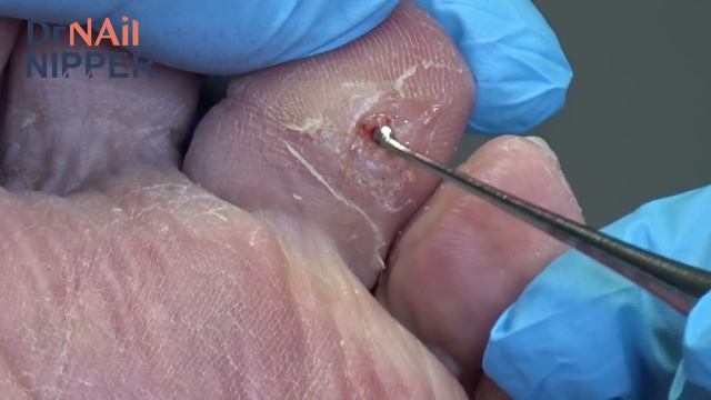 What Is Under The Callus?  [Callus Tuesday] (2020)