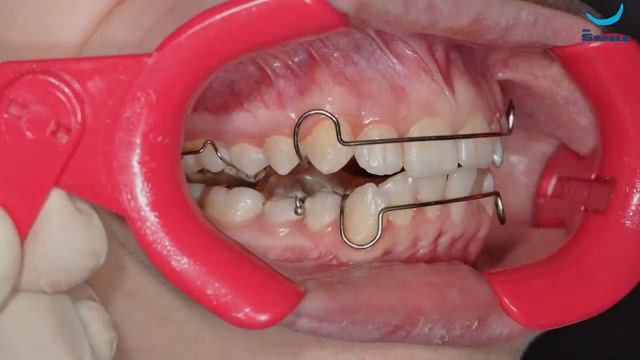 Установка брекет системы Врач Догару А. М. (Клиника dr. Smile) смотреть онлайн