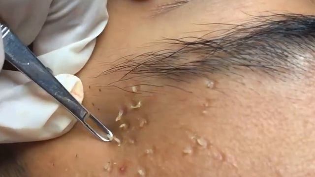 Many Blackheads Removal Best Satisfying Pimple Popping Videos Vlog 2 смотреть онлайн