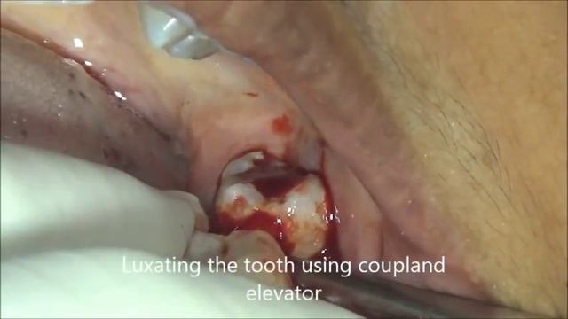 Grossly decayed wisdom tooth extraction using forceps смотреть онлайн