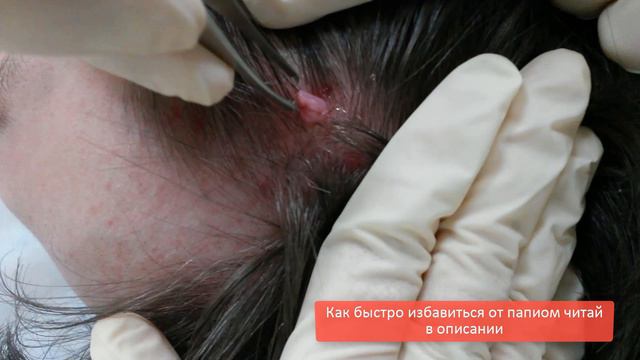 Как быстро избавиться от папилом смотреть онлайн