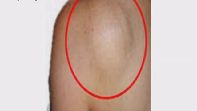 #Lipoma / Malayalam. смотреть онлайн