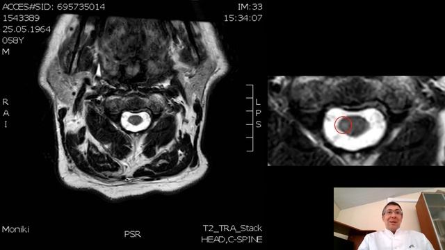 Первично-прогредиентный рассеянный склероз