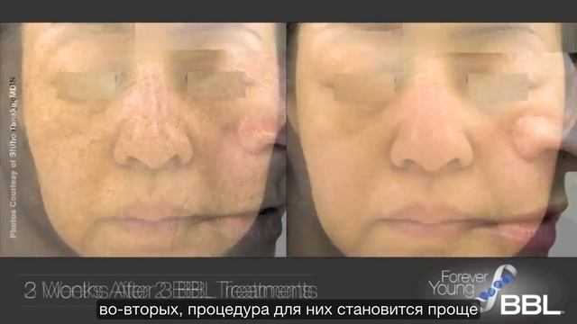 Forever Young BBL Процедура BBL - фотоомоложение