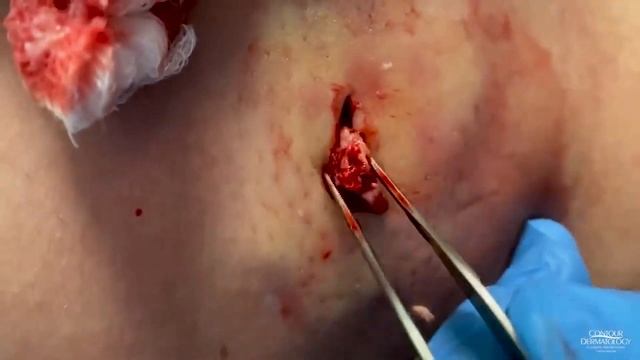 Watch This Giant Cyst SQUIRT! ? смотреть онлайн