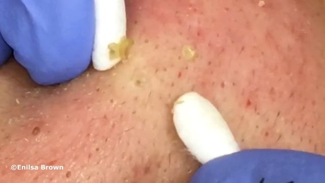 Special "K" Blackhead Extractions 11th Treatment Part 2 смотреть онлайн