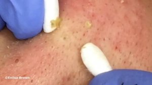 Special "K" Blackhead Extractions 11th Treatment Part 2