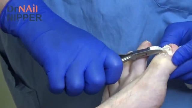 A Really Thick Toenail [Moving The Video Link] (2020)