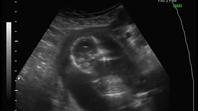 Connor's 3d/4d ultrasound at 15 weeks! смотреть онлайн