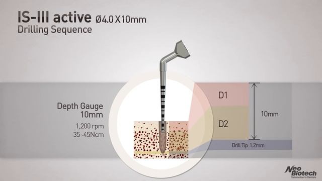 Neobiotech IS-III Active : Features & Drilling Sequence (No BGM)