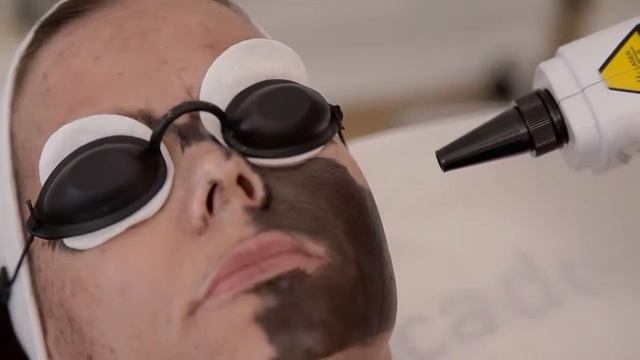 Карбоновый пилинг омоложение. смотреть онлайн