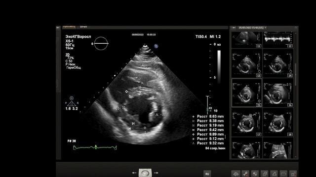 УЗИ сердца .Способ определения индекса массы миокарда площадь длина. смотреть онлайн