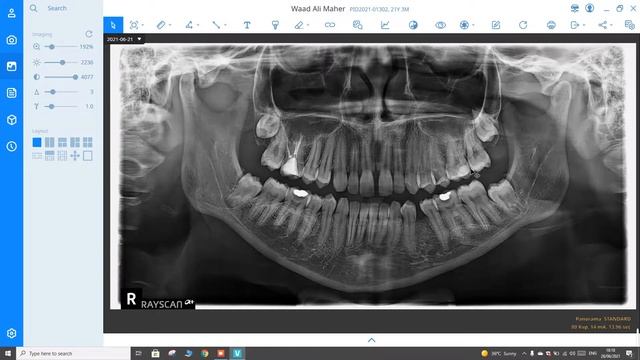 SMARTDENT V3 TUTORIAL 1 смотреть онлайн