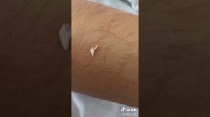 Мой кот погрыз мне руку