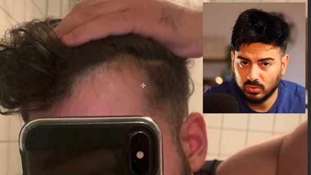 Minoxidil - 2 Monate Erfahrung | Haarausfall Analyse смотреть онлайн