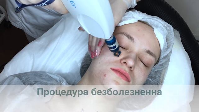 Фракционная лазерная шлифовка смотреть онлайн