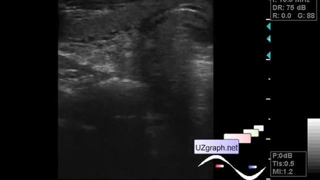 Thyroid ultrasound - Large cystic solid lesion of the thyroid gland смотреть онлайн