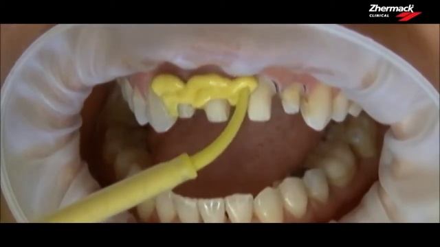 А-силиконовая масса Zhermack Hydrorise Maxi Putty и Extra Light Body смотреть онлайн