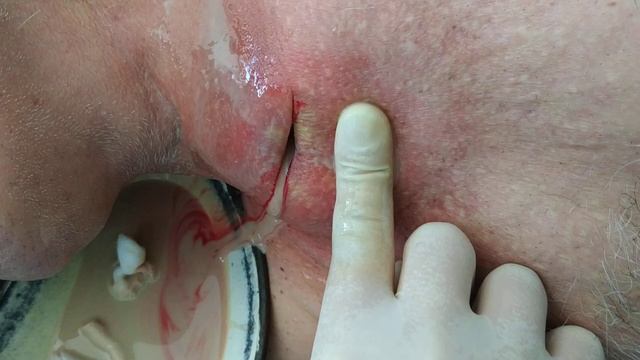 Гнойный медиастинит. Часть 2 . Purulent mediastinitis. Part 2 . смотреть онлайн