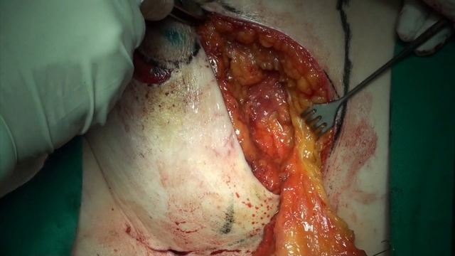 Operation 36 - Vertical Mammoplasty and Sentinel Node Biopsy смотреть онлайн