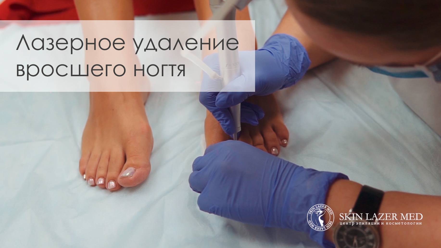 Лазерное удаление вросшего ногтя