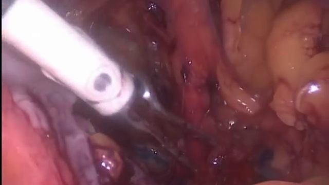 Laparoscopic Pelvic Sentinel Lymph Node Dissection смотреть онлайн