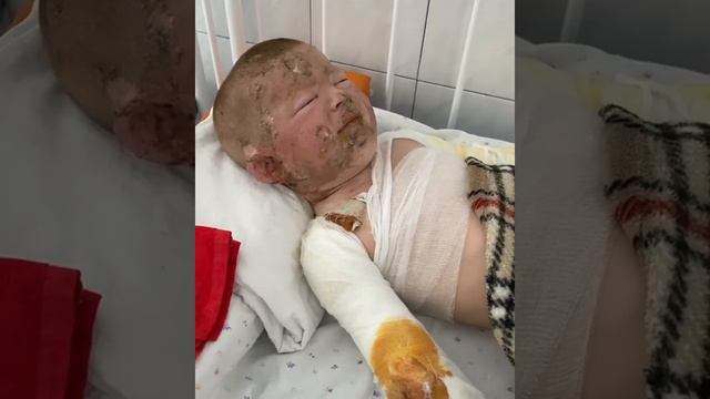 Малыш с ожогами. Запорожье
