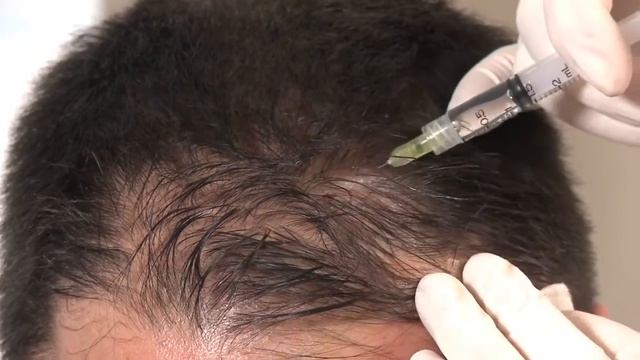 Dermaheal HL   Hair Regrowth