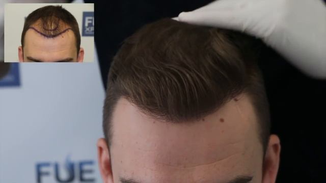 FUE Hair Transplant (2700 Grafts in NW-Class lll-A) Dr. Juan Couto - FUEXPERT CLINIC- Madrid, Spain смотреть онлайн