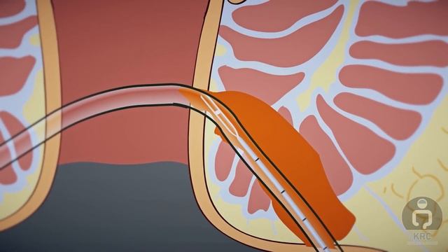 ANAL FISTULA LASER CLOSURE смотреть онлайн