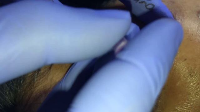 BIG PIMPLE And BLACKHEAD POPPING By DR.LALIT KASANA (21MAY 2019)