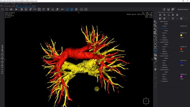 New version of the vessel tree segmentation tool: lung arteries and veins separation case смотреть онлайн