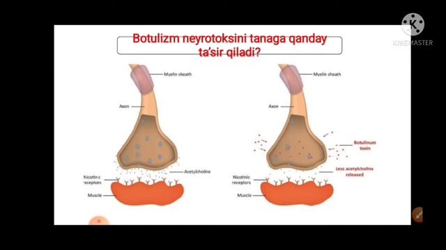 |BOTULIZM KASALLIGI QISQA FORMATDA