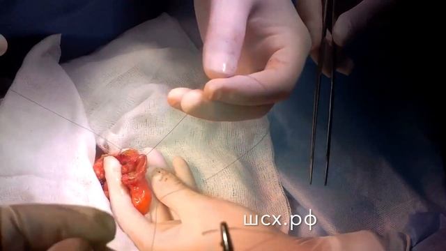 Введение головки РСЕЕА в приводящую кишку смотреть онлайн