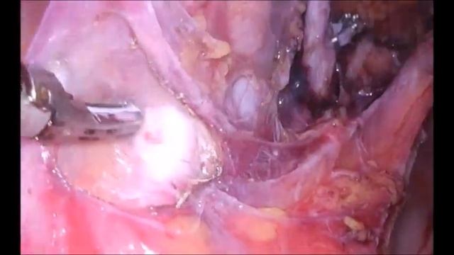 Laparoscopic Pelvic Lymph Node Dissection смотреть онлайн