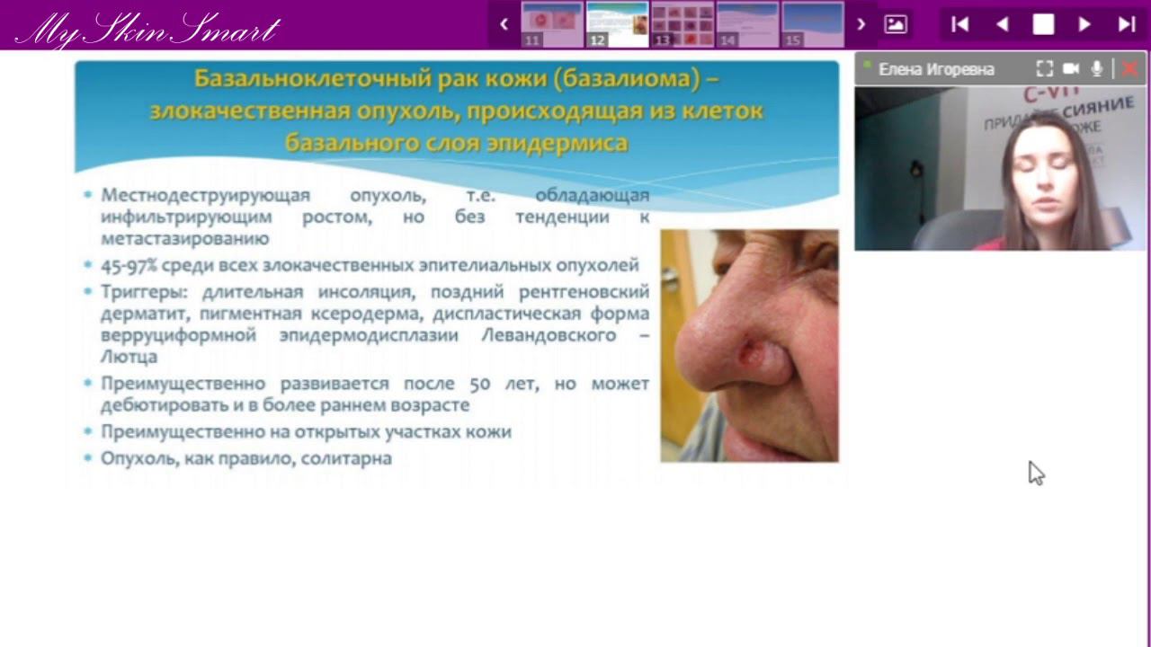 Лекция 18 Невусы и меланома Предраковые заболевания и опухоли кожи смотреть онлайн