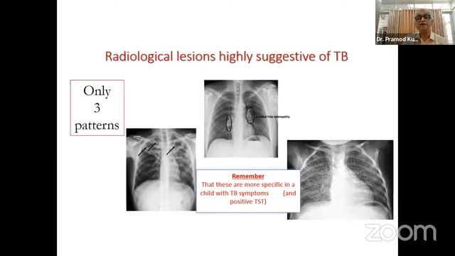 Tuberculosis in Children - IAP Pune смотреть онлайн